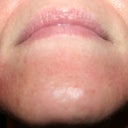 Day #4 chin area - this is the worst-looking area at this point.  I guess because the skin is thinner here.  Not sure if you can see in the picture the tiny pimples that have cropped up.  Some of them have already resolved themselves, but a few remain.