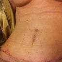 This was at my 3 week pot op appointment. These are the only appointments when I have all tape off so I snapped a quick photo. Everything healing great!