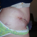 2wks 2 days post op. Im still really swollen and
bruised. But, so satisfied with the results so far. = )