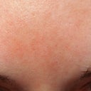 I noticed the track lines this morning on my forehead.  6 days after treatment.  With this lighting you can't see the fact the lines are indented but you can see they are slightly pigmented.  If the pigmenting lightens I think these lines would be barely noticible even if the indents remain.  They are thinner than pore size.