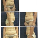Tummy Tuck before