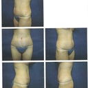 Tummy Tuck after - 15 weeks