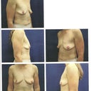 Breasts before