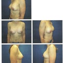 Breasts after - 15 weeks post op - silicone unders