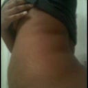 My side profile before the surgery