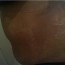 A picture two days after surgery