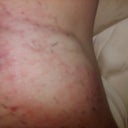 Day 2 - pretty swollen, mostly gone now on day 7.