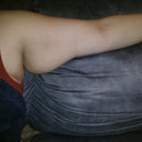 This is my arm before Surgery