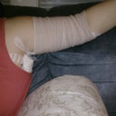 This is my arm swollen and wrapped the day after surgery