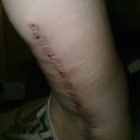 This is 13 days after surgery, the day before the stitches come out