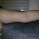 This is still 13 days out, no ace bandage on, still very swollen.