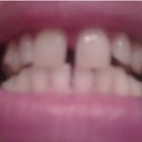 Beginning of Tray 2- without Invisalign