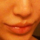 2 wks after Juvederm Ultra Plus, volume is dramatically lower