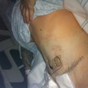 Day 1 Post op, still at the surgery center