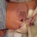 Day 1 post op, still at the surgery center