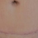My 6 mo. PO scar.