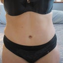 Front view 6 mo. PO