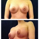 3 weeks Post Op (Day 21)
