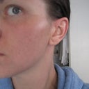 Taken Feb 20th ( almost a month since my procedure) straight out of the shower so I think this looks a bit more pink than normal because I just showered.  So impressed, better everyday.