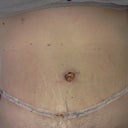 2 days post op
