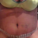 ok here are my after pics... 1 week and a couple days post op... a lil bruised alot of it disappeared