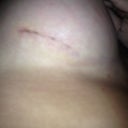 Right incision 1 week post op