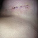 Left incision 1 week post op