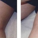 Stretch Marks