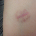 I dont have any before pictures but this is the scar I have from the Lipoma removal. Its only about a half inch long...