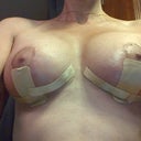 7 weeks post op