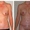 before and after at 2 weeks