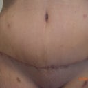 front view 5 weeks post op