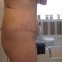 side view 5 weeks post op
