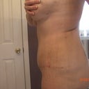 side view 5 weeks post op