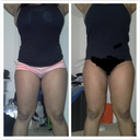 21 days post op comparison pic. I still have more swelling in my right leg vs my left. The swelling feelings like hard lumps.