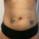 Before - Stretch marks with saggy skin