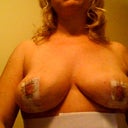 17 days post op