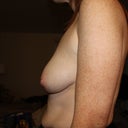 Left breast fuller than right
