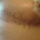 2wks PO side - steri strip irritation