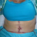 Post Op Day 7.  Swelllllllling like crazy.  This ended up not being such a "swell" day for me.  :)  Rough night that night.