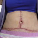 Post Op Day 9.