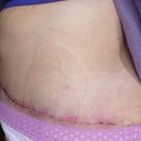 Post Op Day 9.