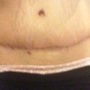 Scar 4 months post op. hides well underneath 
 panties and pants. The red mark below the scar is a tear. It going away and didn't bother me.