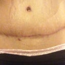 Scar after 4 months post op
