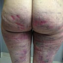 Post Op - June 6, 2012 - 24 hours after cellulaze