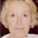 Liquid Face Lift Using Botox, Pixel Laser, Restylane, Botox And Platelet Rich Plasma