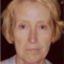 Liquid Face Lift Using Botox, Pixel Laser, Restylane, Botox And Platelet Rich Plasma