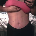 7 days post op
