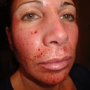 next morning after procedure-18 hrs after-