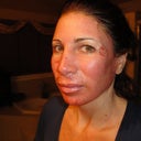 next morning after procedure-18 hrs after